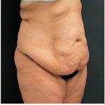 Abdominoplasty Before & After Patient #15907