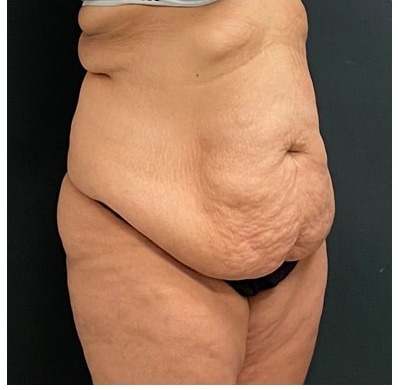 Abdominoplasty Before & After Patient #15907