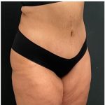 Abdominoplasty Before & After Patient #15907