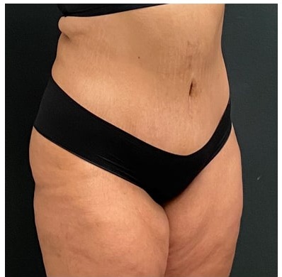 Abdominoplasty Before & After Patient #15907