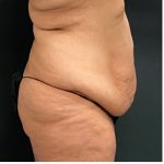 Abdominoplasty Before & After Patient #15907