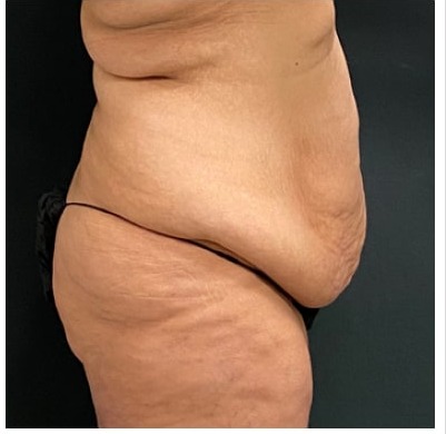 Abdominoplasty Before & After Patient #15907