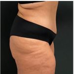 Abdominoplasty Before & After Patient #15907