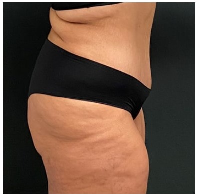 Abdominoplasty Before & After Patient #15907