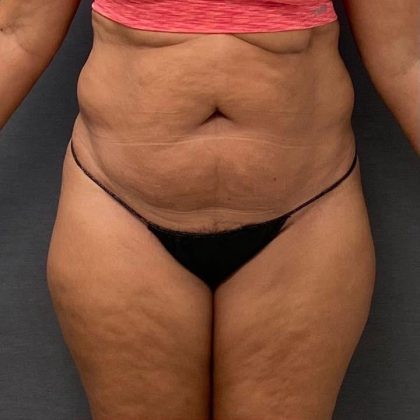 Abdominoplasty Before & After Patient #15943