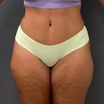 Abdominoplasty Before & After Patient #15943