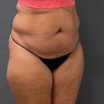 Abdominoplasty Before & After Patient #15943