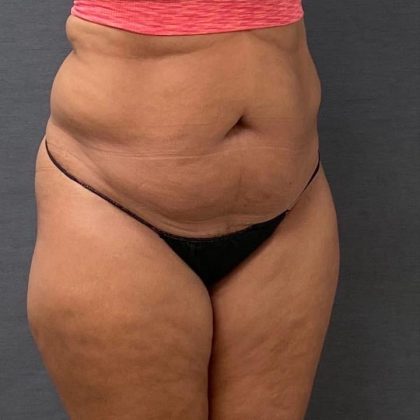 Abdominoplasty Before & After Patient #15943