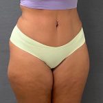 Abdominoplasty Before & After Patient #15943