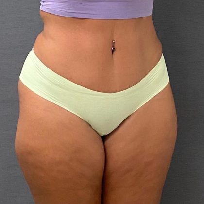 Abdominoplasty Before & After Patient #15943