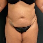 Abdominoplasty Before & After Patient #15944