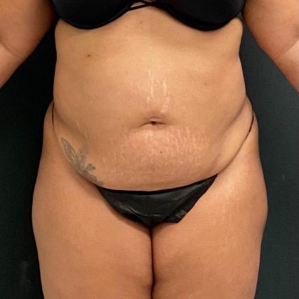Abdominoplasty Before & After Patient #15944