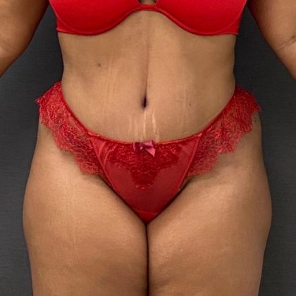 Abdominoplasty Before & After Patient #15944