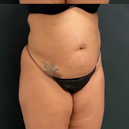 Abdominoplasty Before & After Patient #15944