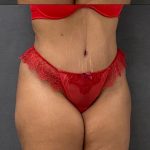 Abdominoplasty Before & After Patient #15944