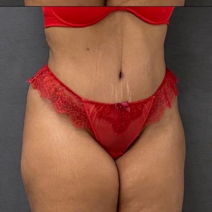 Abdominoplasty Before & After Patient #15944
