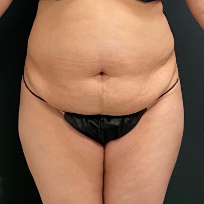 Abdominoplasty Before & After Patient #15945