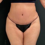 Abdominoplasty Before & After Patient #15945