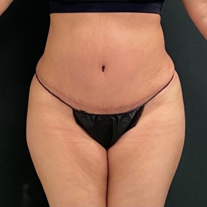 Abdominoplasty Before & After Patient #15945