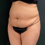 Abdominoplasty Before & After Patient #15945