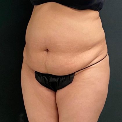 Abdominoplasty Before & After Patient #15945