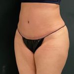 Abdominoplasty Before & After Patient #15945