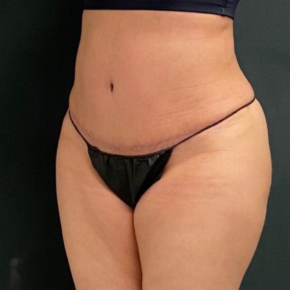 Abdominoplasty Before & After Patient #15945