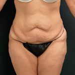Abdominoplasty Before & After Patient #15946