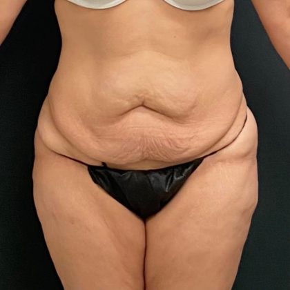 Abdominoplasty Before & After Patient #15946