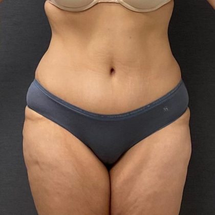 Abdominoplasty Before & After Patient #15946