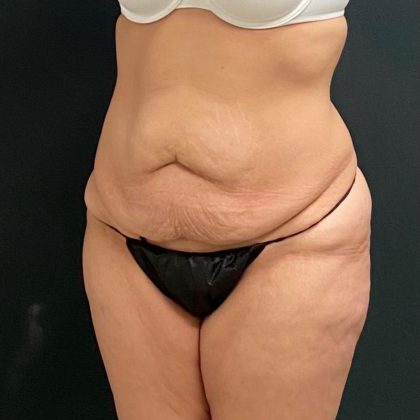Abdominoplasty Before & After Patient #15946