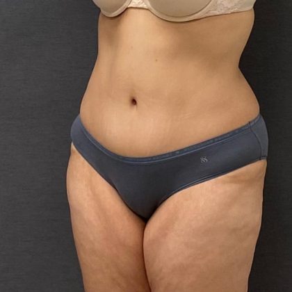 Abdominoplasty Before & After Patient #15946