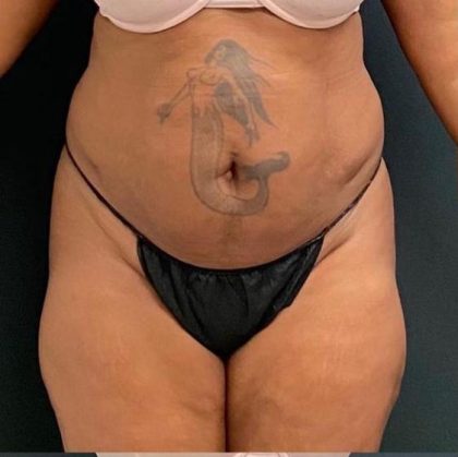 Abdominoplasty Before & After Patient #15947