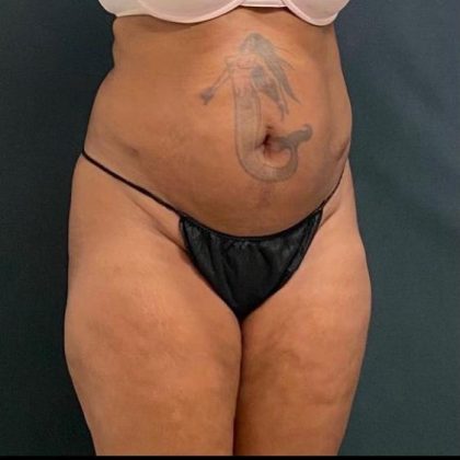 Abdominoplasty Before & After Patient #15947
