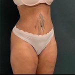 Abdominoplasty Before & After Patient #15947