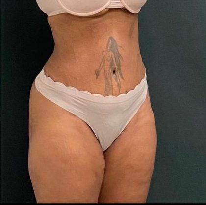 Abdominoplasty Before & After Patient #15947