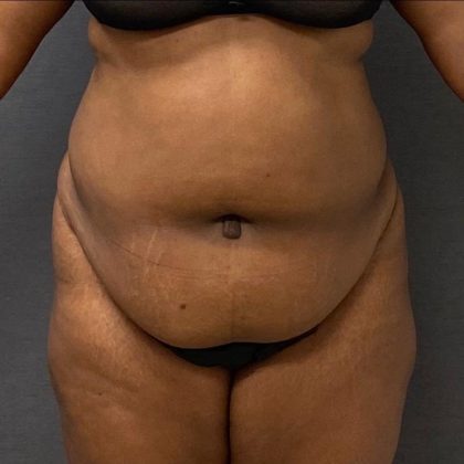 Abdominoplasty Before & After Patient #15948