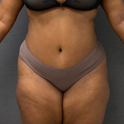 Abdominoplasty Before & After Patient #15948