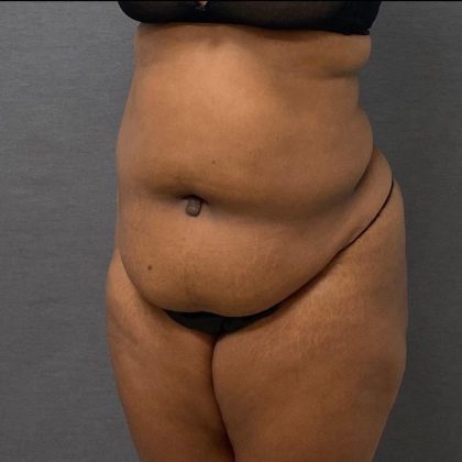 Abdominoplasty Before & After Patient #15948