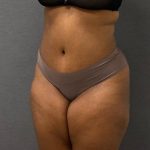 Abdominoplasty Before & After Patient #15948