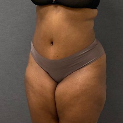 Abdominoplasty Before & After Patient #15948