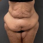 Abdominoplasty Before & After Patient #15949