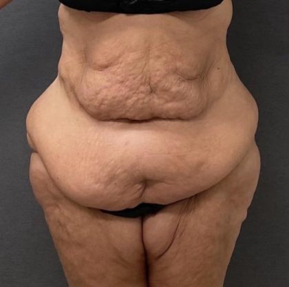 Abdominoplasty Before & After Patient #15949
