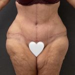 Abdominoplasty Before & After Patient #15949