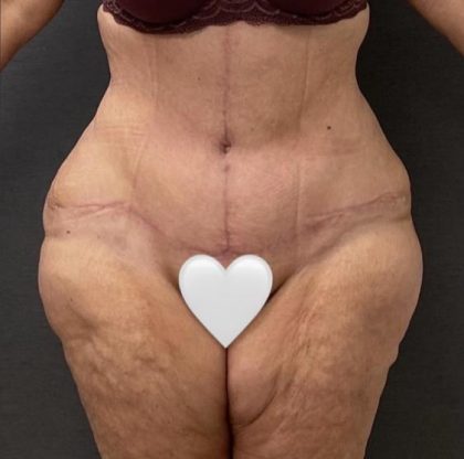 Abdominoplasty Before & After Patient #15949