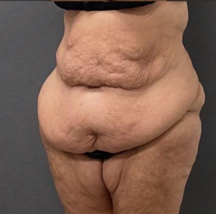 Abdominoplasty Before & After Patient #15949