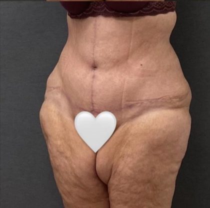 Abdominoplasty Before & After Patient #15949