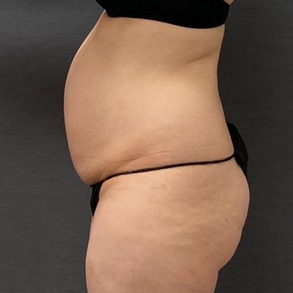 Abdominoplasty Before & After Patient #15950
