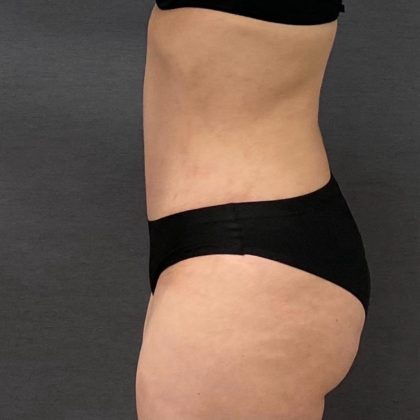 Abdominoplasty Before & After Patient #15950
