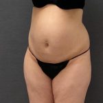 Abdominoplasty Before & After Patient #15950